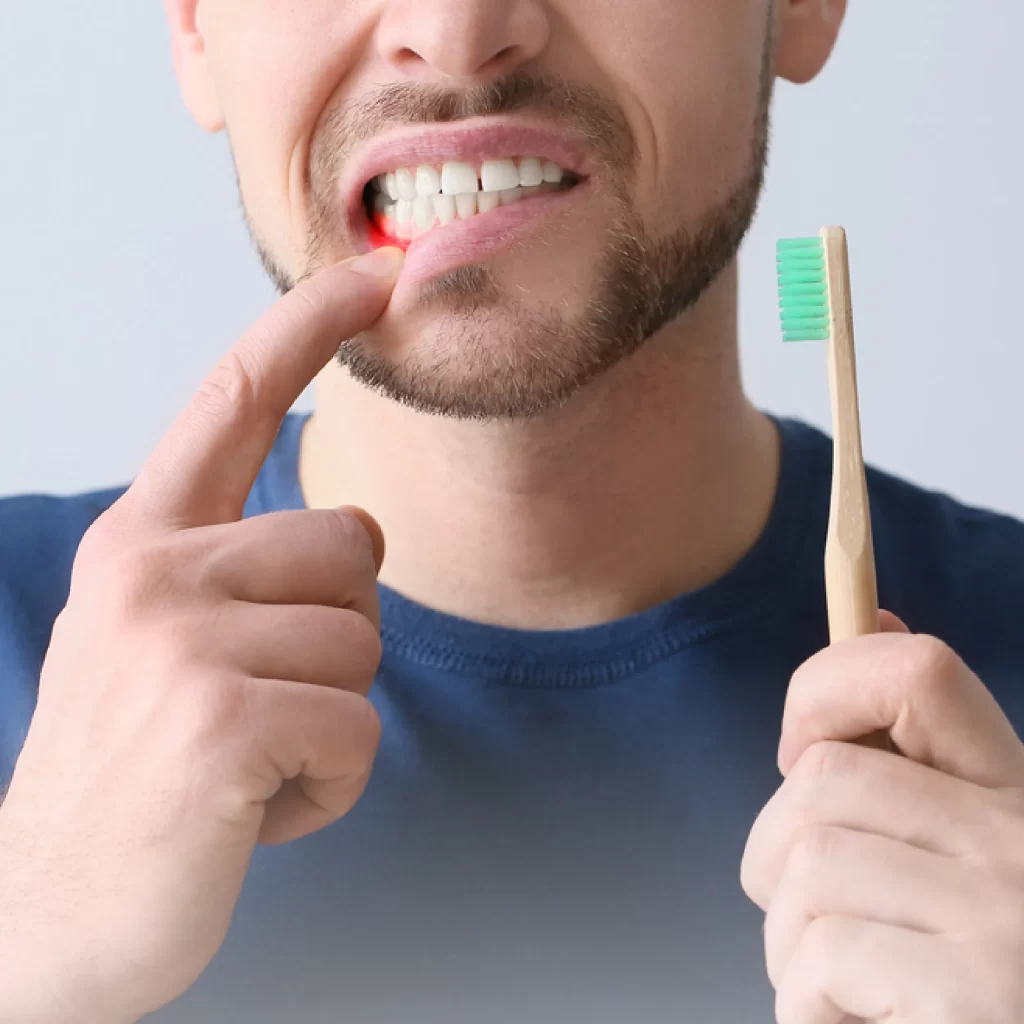 First signs of gingivitis -photo