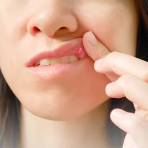 اعراض قرح الفم المؤلمة