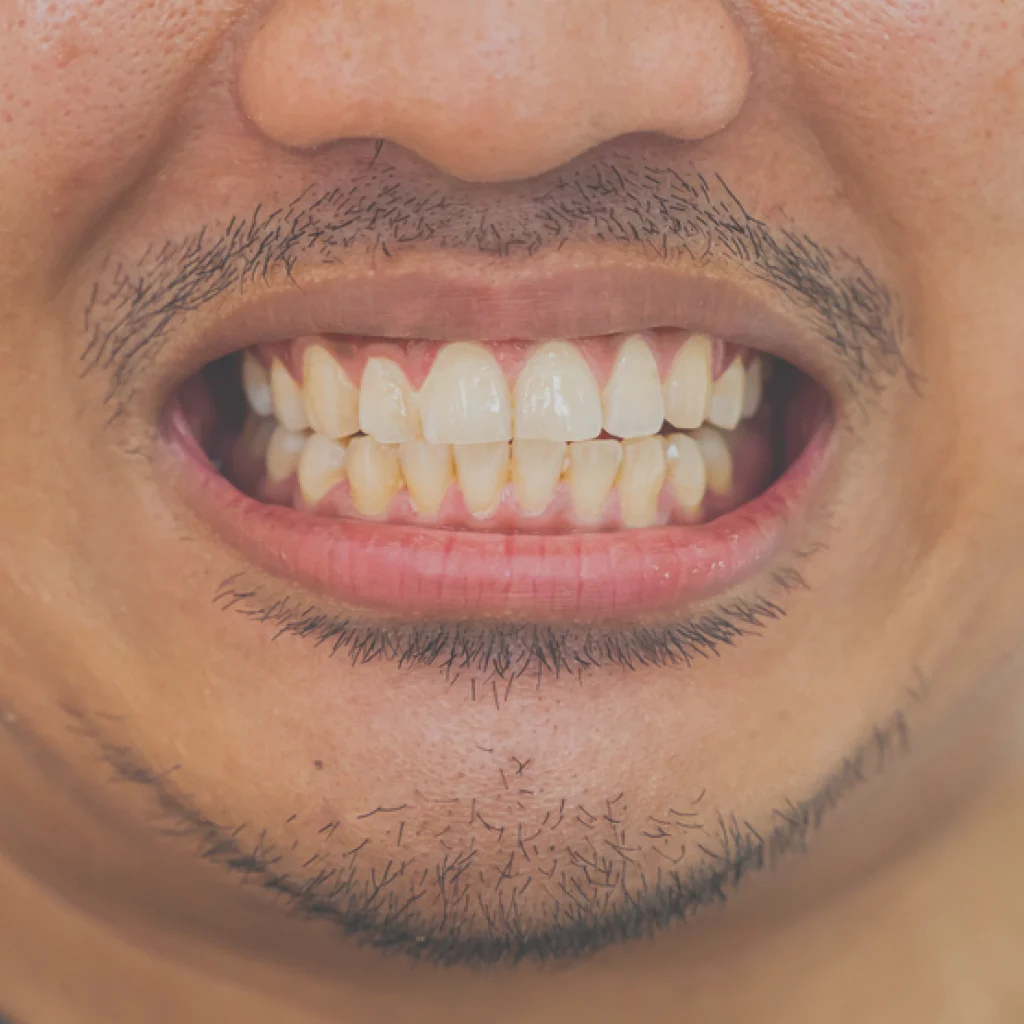 ماذا نعني بتغيير لون الأسنان Teeth Discoloration